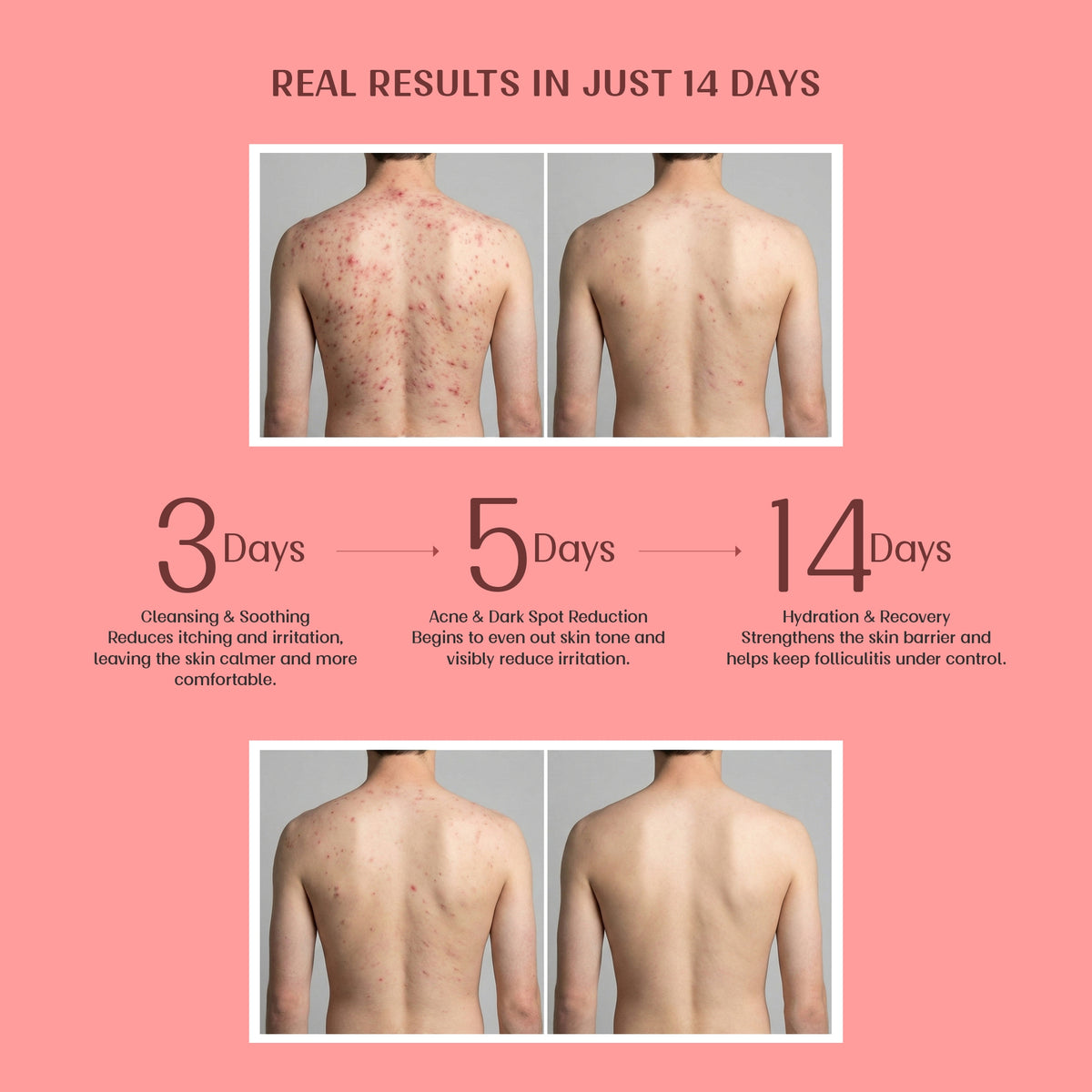Exfoliating Body Wash with Salicylic Acid for Body Acne & Rough Bumpy Skin | Reduce Strawberry Legs - Velleja