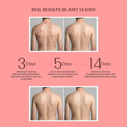 Exfoliating Body Wash with Salicylic Acid for Body Acne & Rough Bumpy Skin | Reduce Strawberry Legs - Velleja